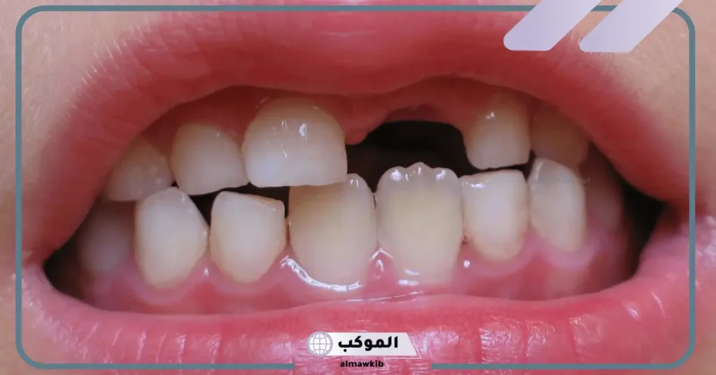 تفسير حلم كسر السن في المنام للعزباء والمتزوجة لابن سيرين 6 تفسير حلم كسر السن بدون دم