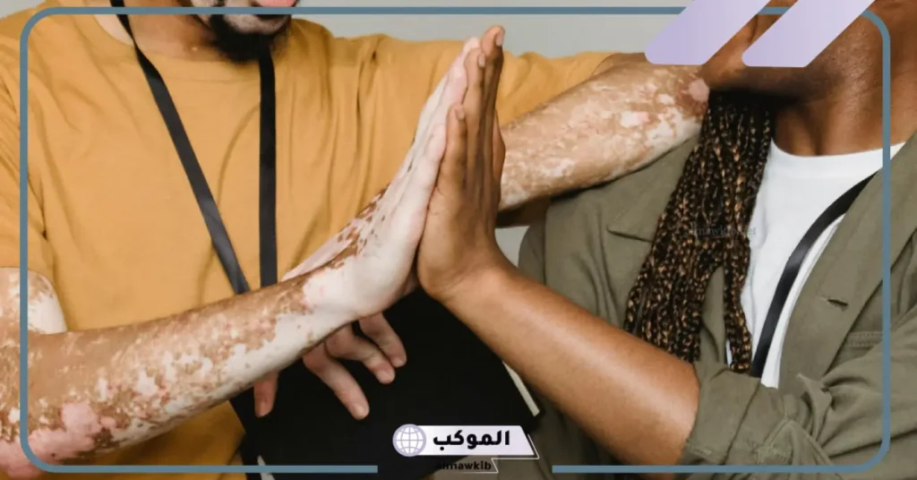 تفسير حلم البهاق في اليدين للعزباء