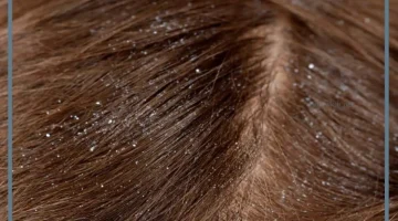 الحلم بالقمل في المنام