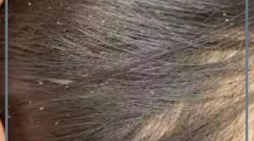 القمل في الحلم