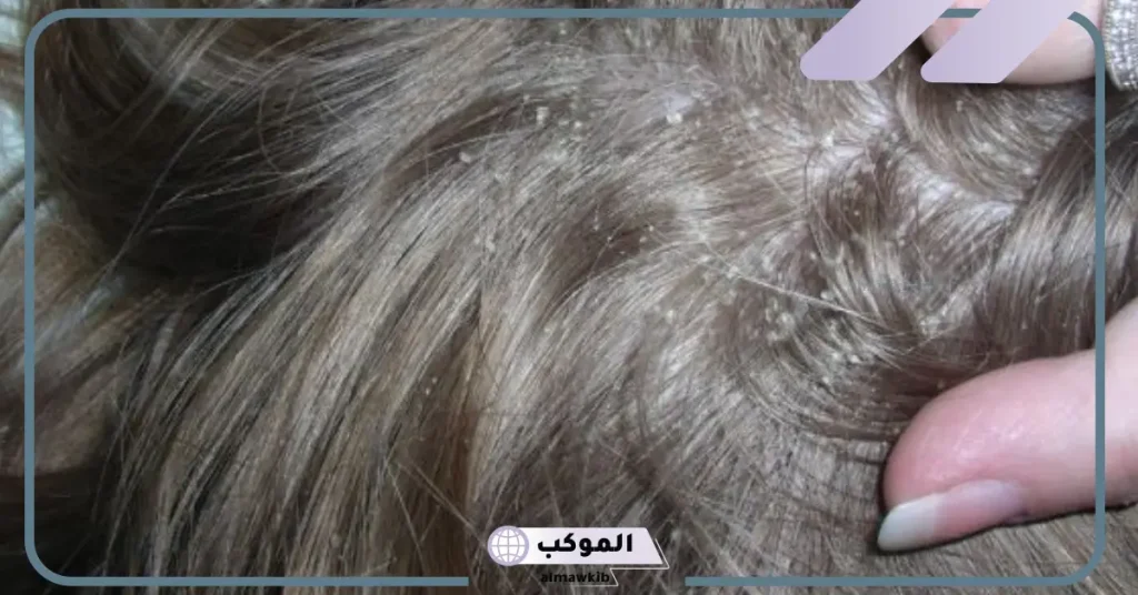 تفسير حلم نزع القمل من الشعر للعزباء