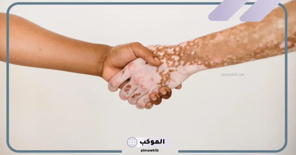 تفسير حلم البهاق للرجل