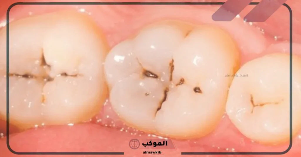 تفسير حلم تسوس الاسنان للعزباء 