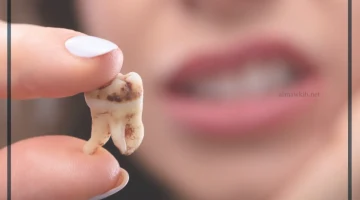 تفسير حلم تسوس الاسنان