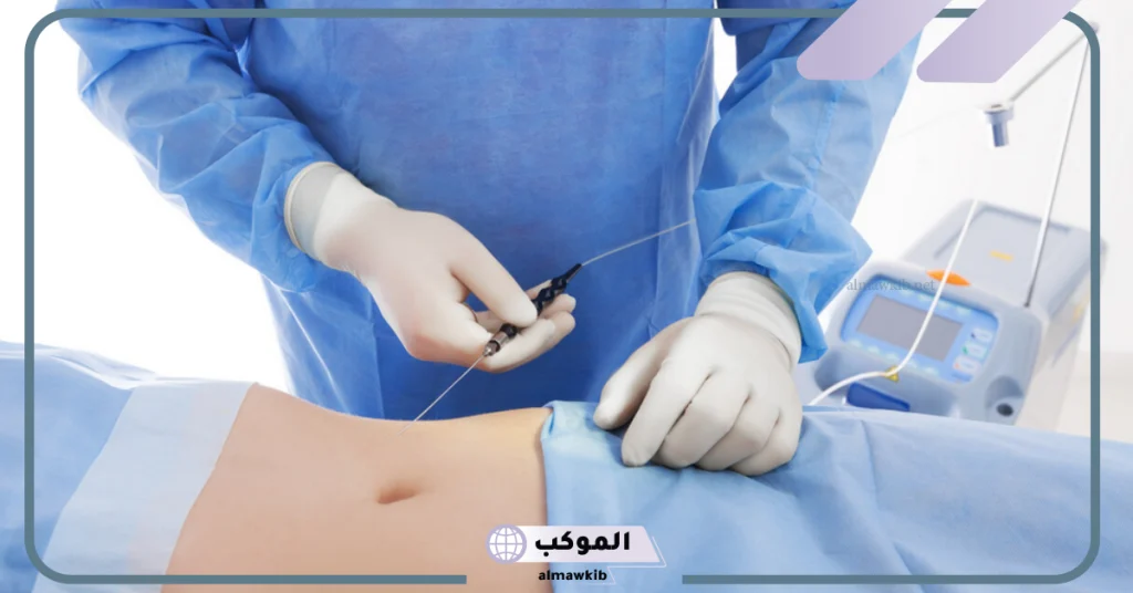 تجربتي مع عملية شفط الدهون بمميزاتها وأضرارها 6 عيوب شفط الدهون بالفيزر