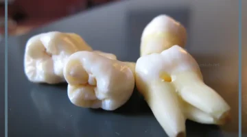 حلمت بخلع الضرس