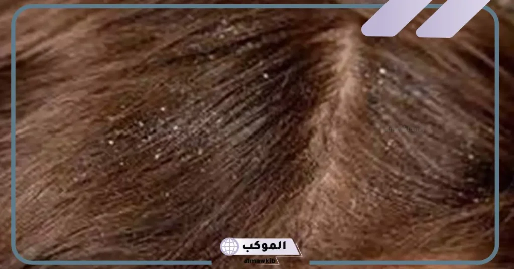 تفسير حلم القمل الأسود في الشعر للمتزوجة وقتلة