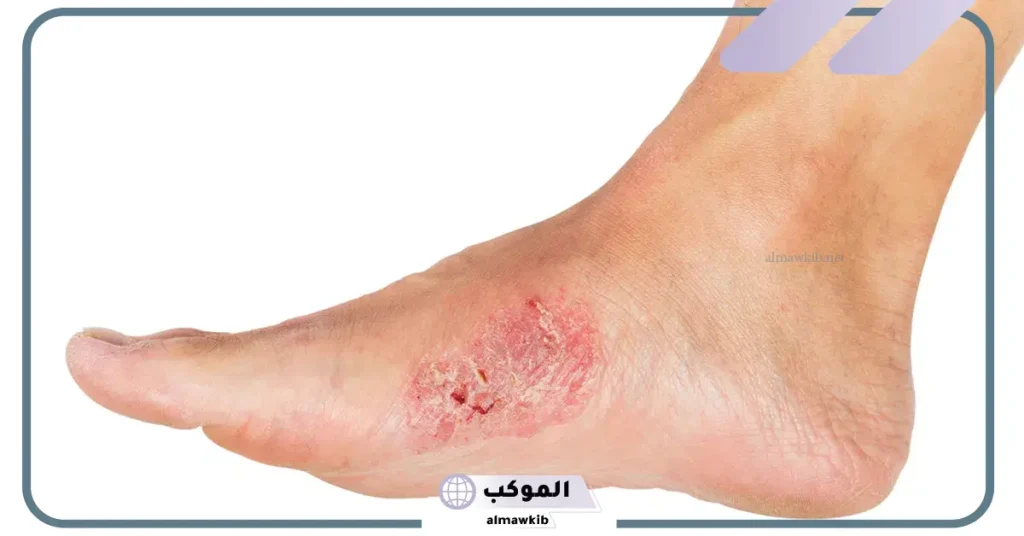 تفسير حلم جرح القدم وخروج الدم