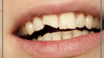 رؤية كسر السن في المنام