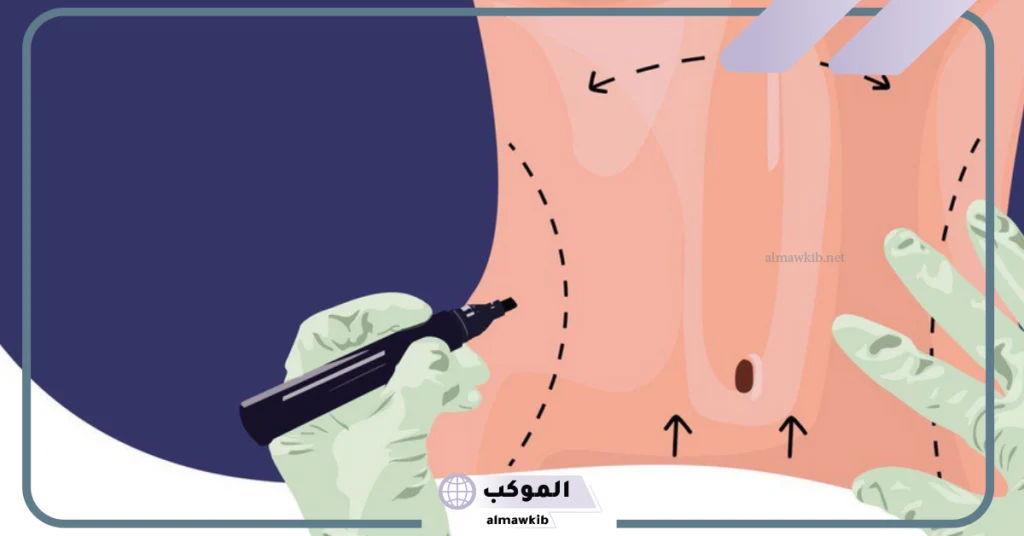 تجربتي مع عملية شفط الدهون بمميزاتها وأضرارها 5 تجربتي مع عملية شفط الدهون بالفيزر عالم حواء