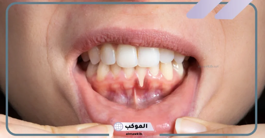 علاج تراجع اللثة بالملح   