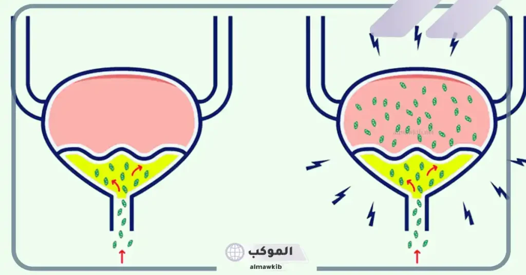 علاج التهاب المسالك البولية بالملح