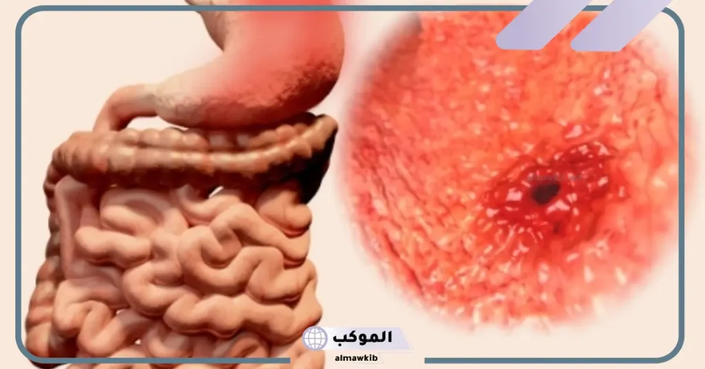 علاج قرحة المعدة من الصيدلية