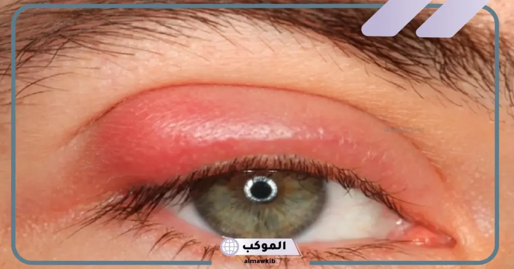 علاج الرمد للأطفال بالمنزل