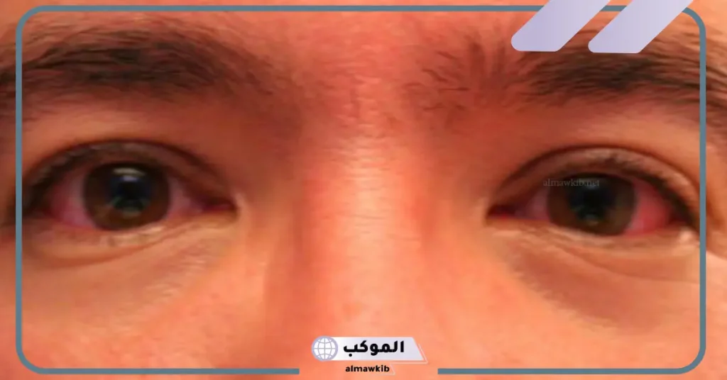 علاج الرمد بسرعة