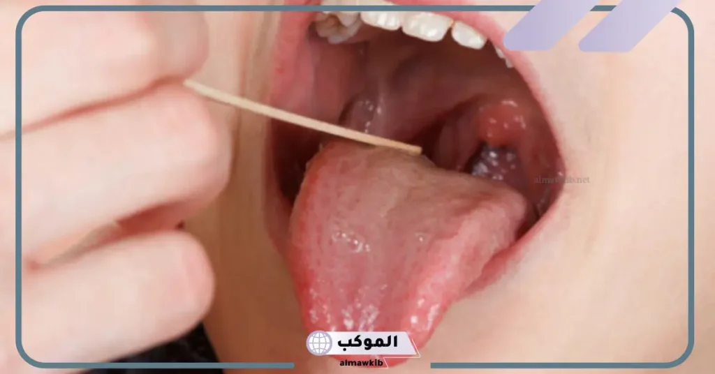 نظام التغذية بعد استئصال اللوزتين