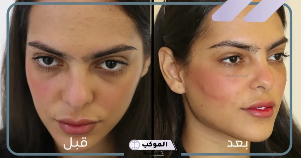 أضرار الفيلر تحت العين