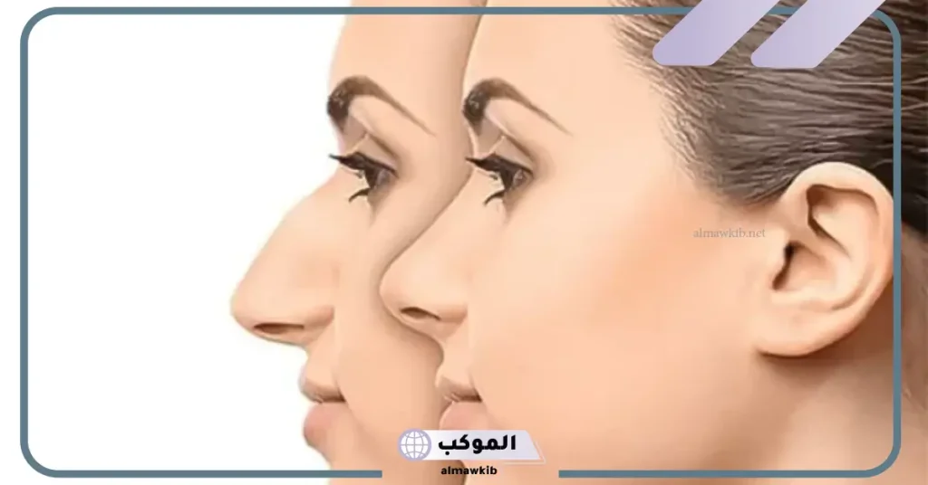 تجربتي مع عملية تجميل الانف والنتيجة ومدة الشفاء 5 مدة الشفاء من عملية تجميل الأنف