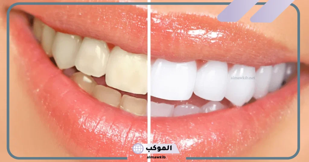 تجربتي مع ازالة جير الاسنان في المنزل بدون طبيب 5 إزالة جير الأسنان بالملح