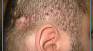 البصيلات الملتهبة