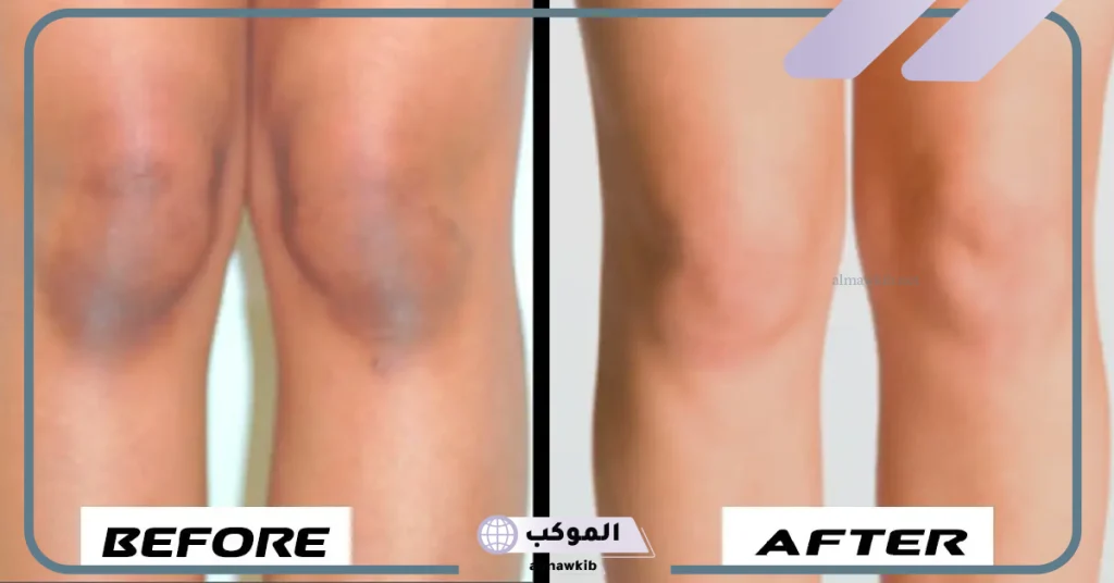 تجربتي مع التقشير البارد للركب