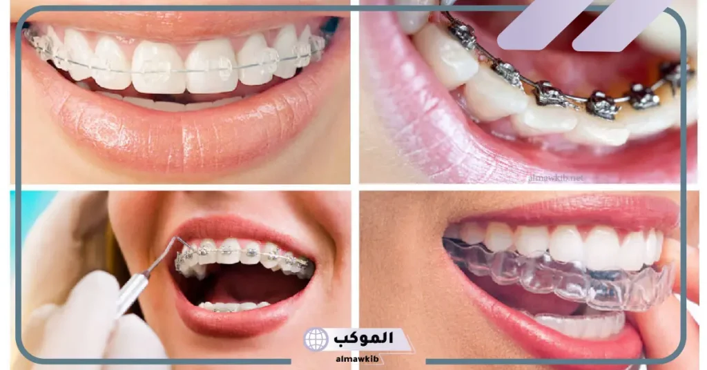 تجربتي مع التقويم الشفاف والنتيجة.. مدة لبس التقويم الشفاف  5 سعر التقويم الشفاف بالريال السعودي