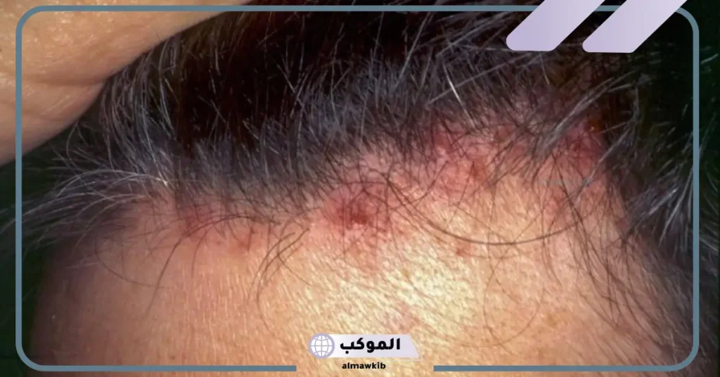 علاج التهاب بصيلات الشعر في فروة الرأس