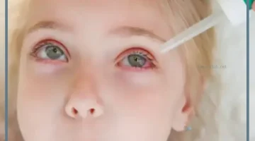 التهاب العين