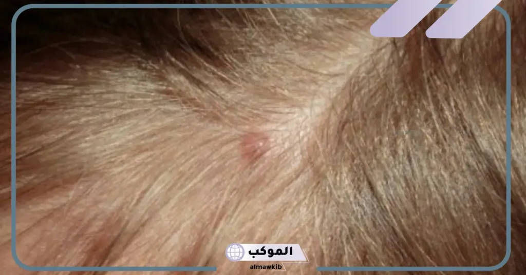 علاج التهاب بصيلات الشعر طبيعياً