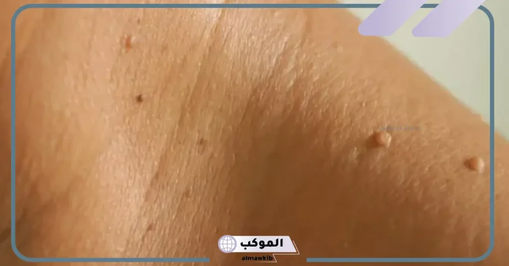 تفسير رؤية الثآليل في المنام والزوائد اللحمية لابن سيرين 6 رؤية الثالول في اليد في المنام