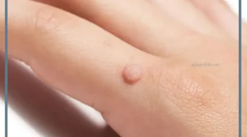 الثالول في الحلم