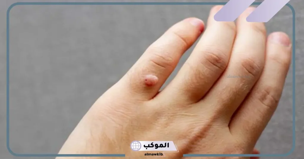 تفسير رؤية الثآليل في المنام والزوائد اللحمية لابن سيرين 5 تفسير رؤية زوائد لحمية في المنام للمتزوجة