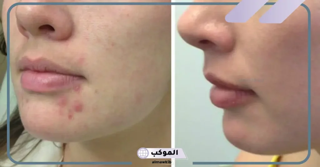 نتائج الروكتان بعد أسبوع