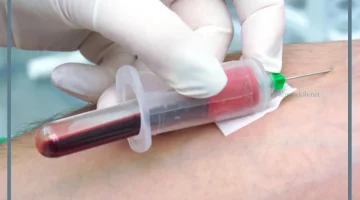 الفصد لعلاج الامراض