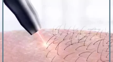 الليزر للتفتيح