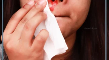 النزيف في المنام