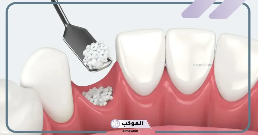 بديل زراعة عظم الفك