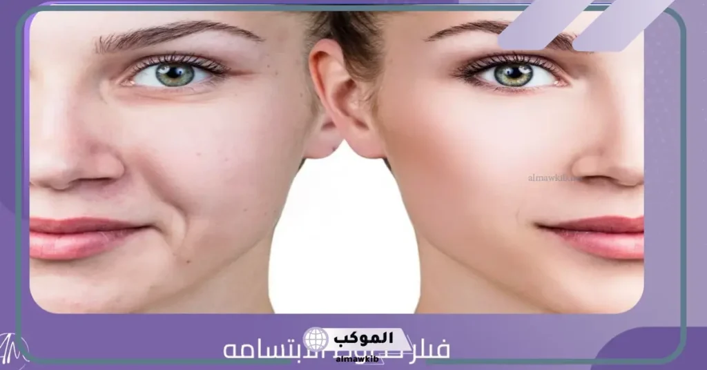 تجربتي مع فيلر الخدود للحصول على خدين ممتئلين 6 كم ابرة فيلر يحتاج الوجه؟