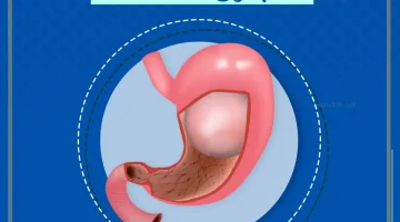 انفجار البالون
