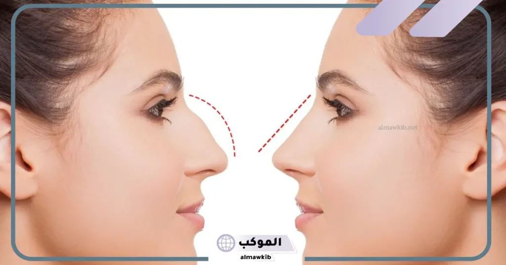 تجربتي مع عملية تجميل الانف والنتيجة ومدة الشفاء 6 الخوف من عملية تجميل الأنف