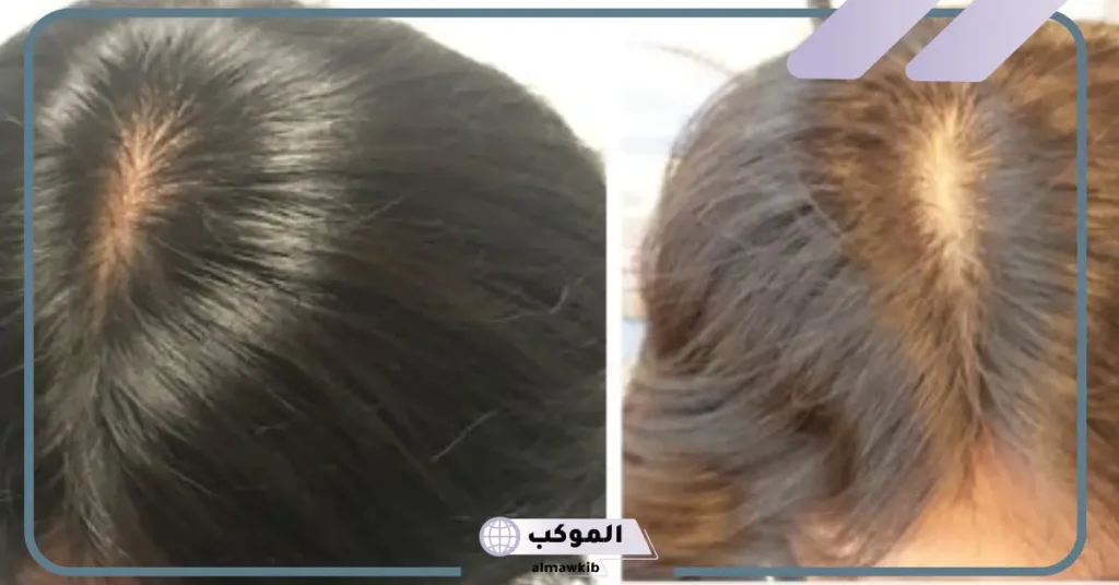 طريقة استخدام حبوب الزنك للشعر