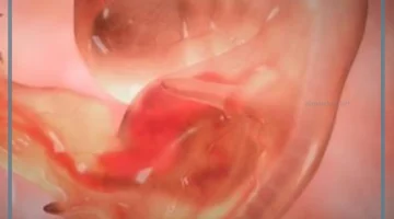 تأخر كيس الحمل