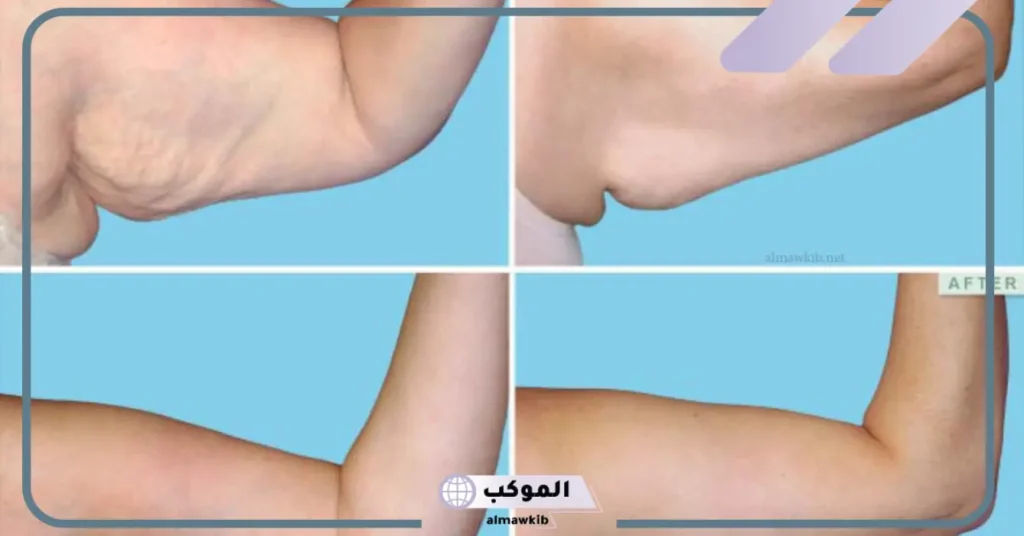 تجربتي مع تنحيف الزنود في أسبوع والنتيجة 6 تنحيف الزنود في اسبوع