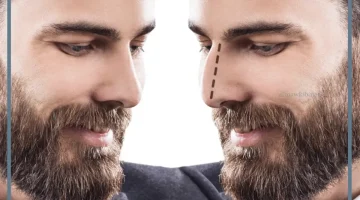 تجميل الأنف