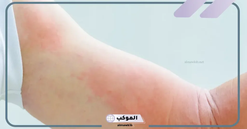 تجربتي مع تحليل حساسية الطعام كاملة 6 علاج حساسية الطعام في المنزل