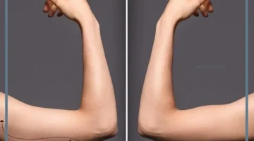 تخسيس الزنود