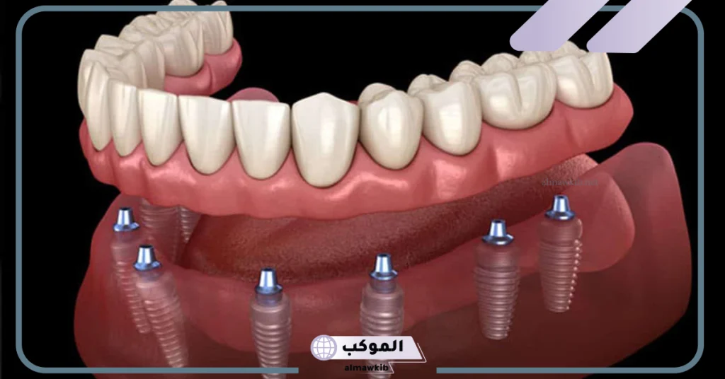 كم مدة زراعة السن الواحد
