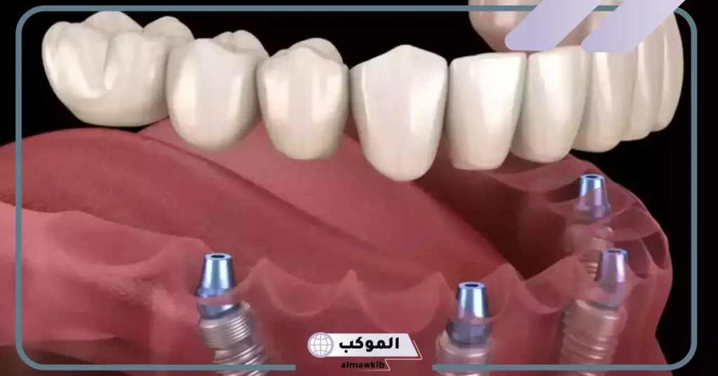 تكلفة زراعة عظم الفك