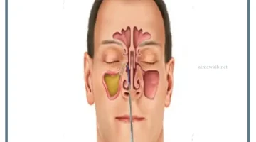 تشوه الجيوب الانفية