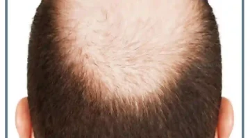 تفسير حلم الصلع في جزء من الراس